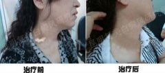 脖颈白癜风康复病例：职业女经理人不再受白斑困扰